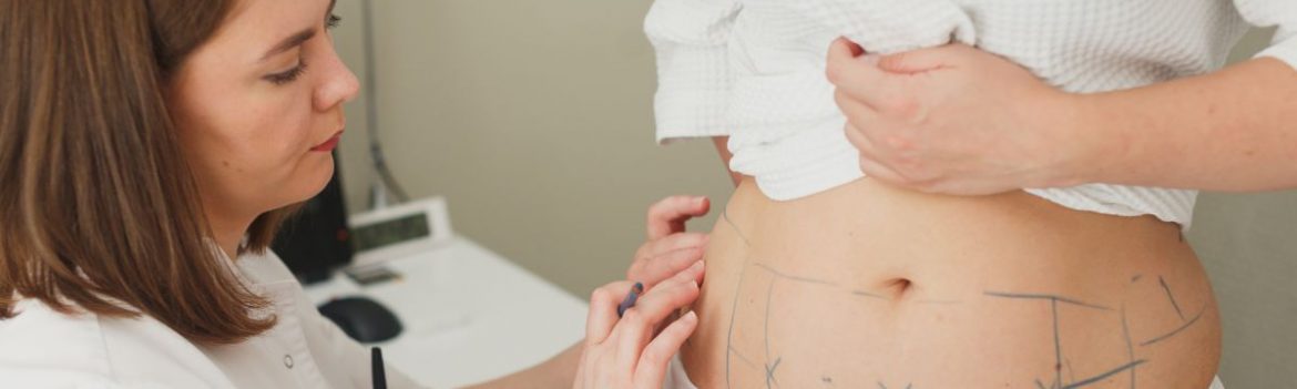 Wann bezahlt die gesetzliche Kasse eine Fettabsaugung?