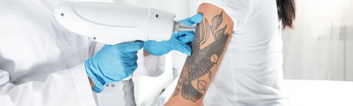 Tattoo-Entfernung